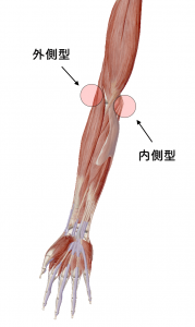 野球肘　内側型・外側型