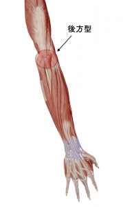野球肘　後方型