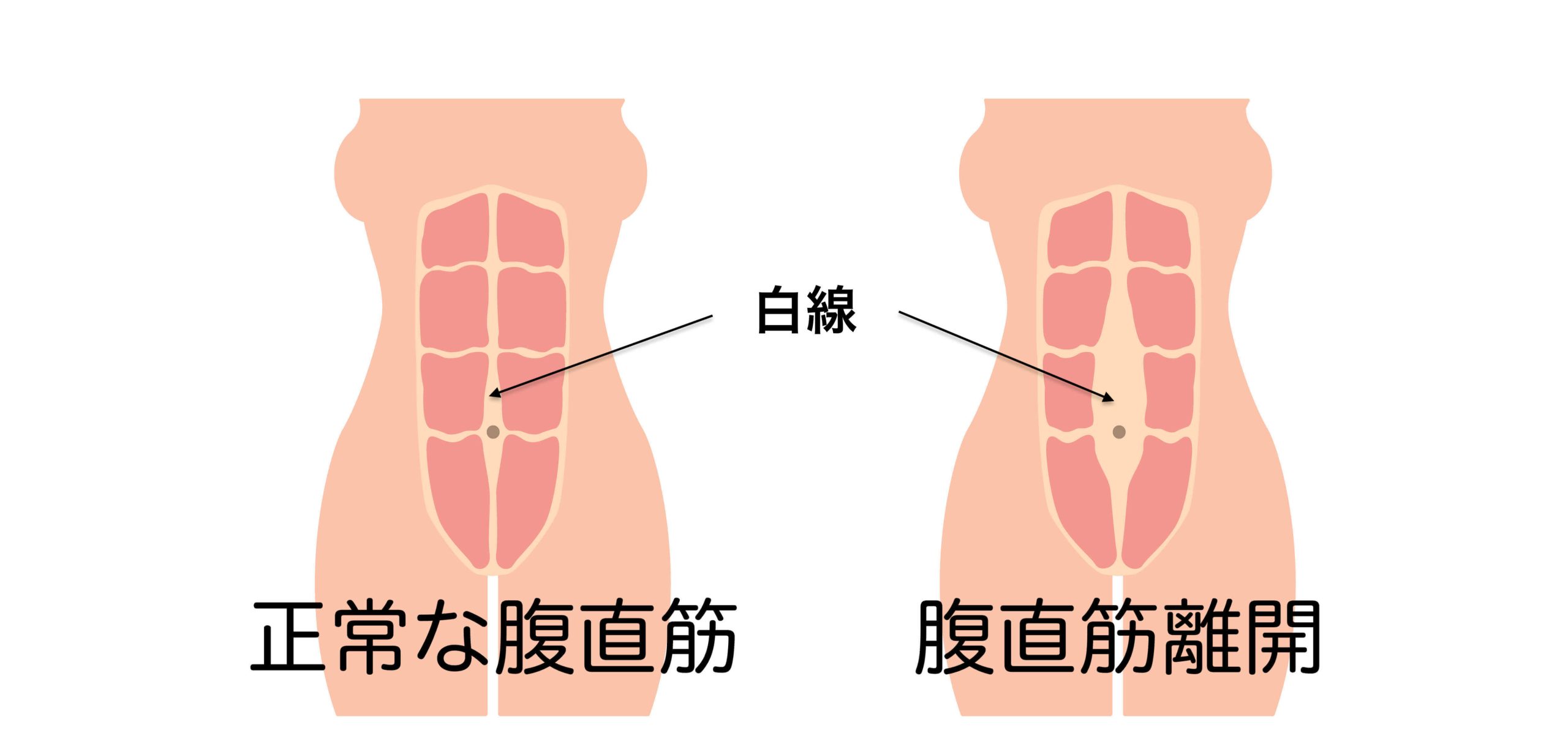 腹直筋