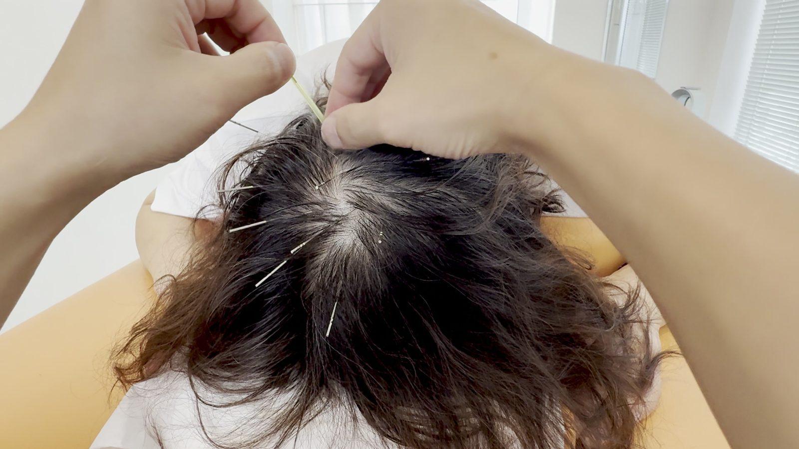 頭皮に鍼を置いていく施術の様子