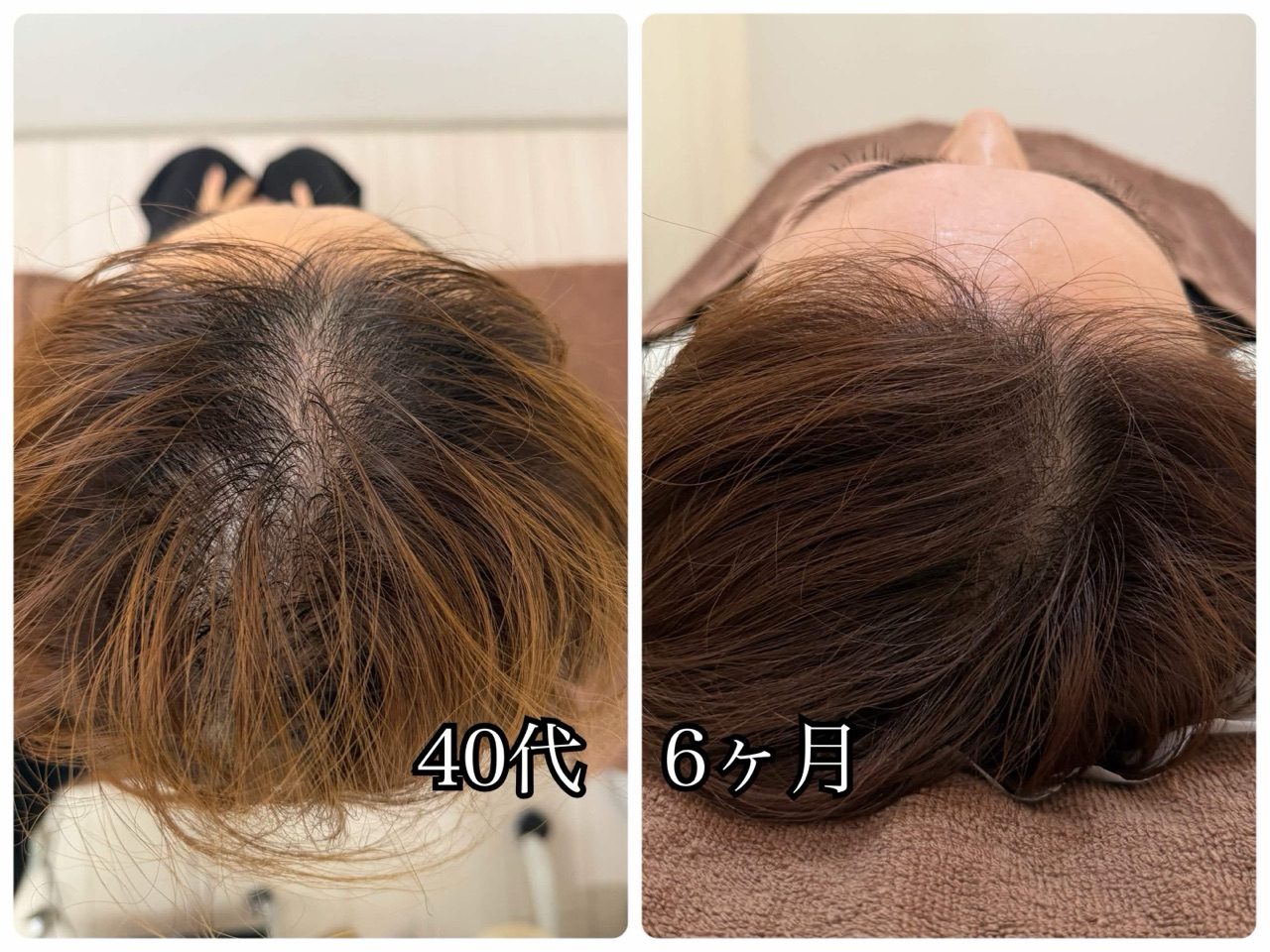 頭頂部の経過写真(40代・6か月)