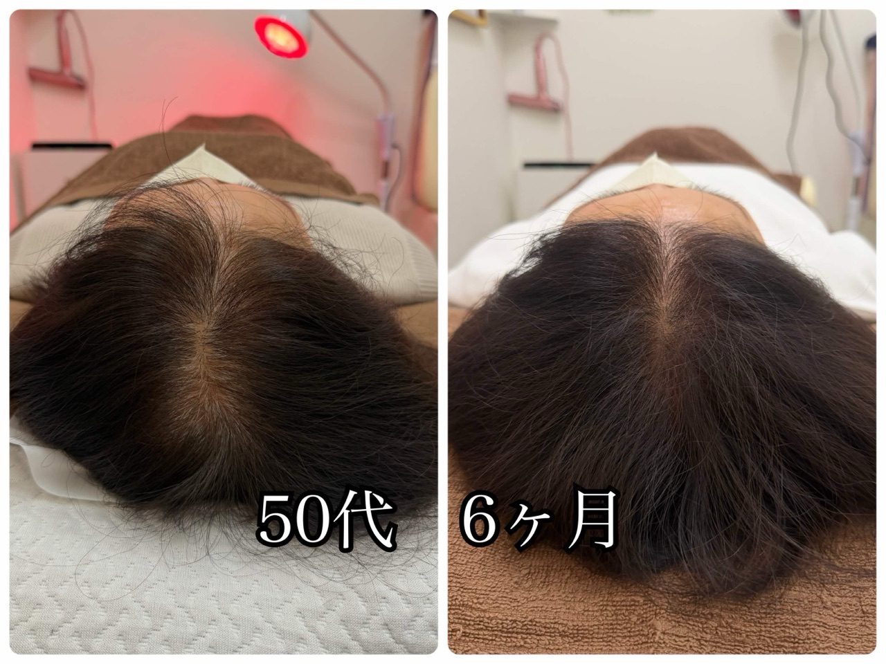 頭頂部の経過写真(50代・6か月)