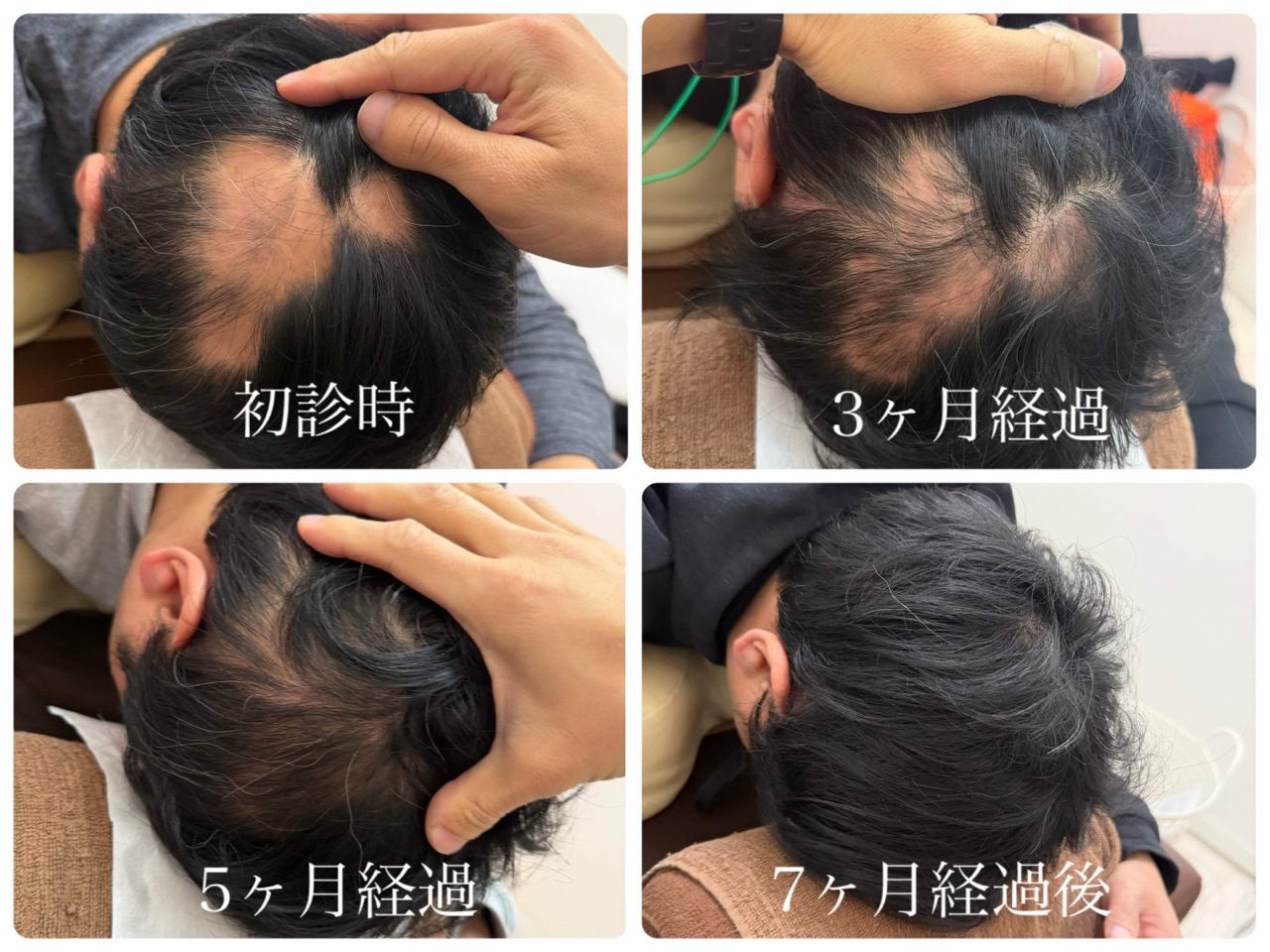 円形脱毛症の経過写真(初診時→7か月)